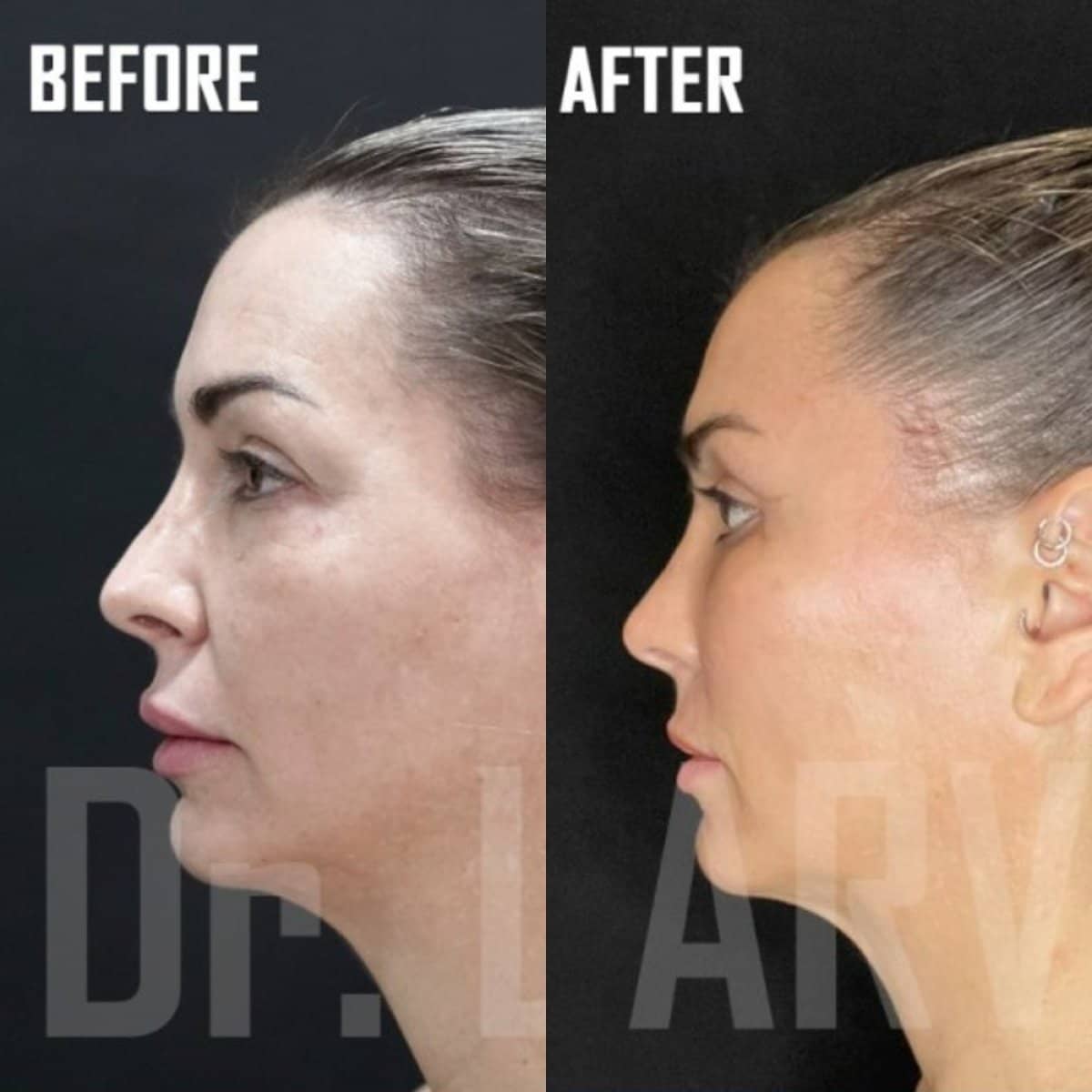 Case 17936 - endoscopic facelift