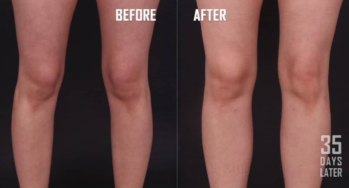 Case 17939 - Vaser liposuction