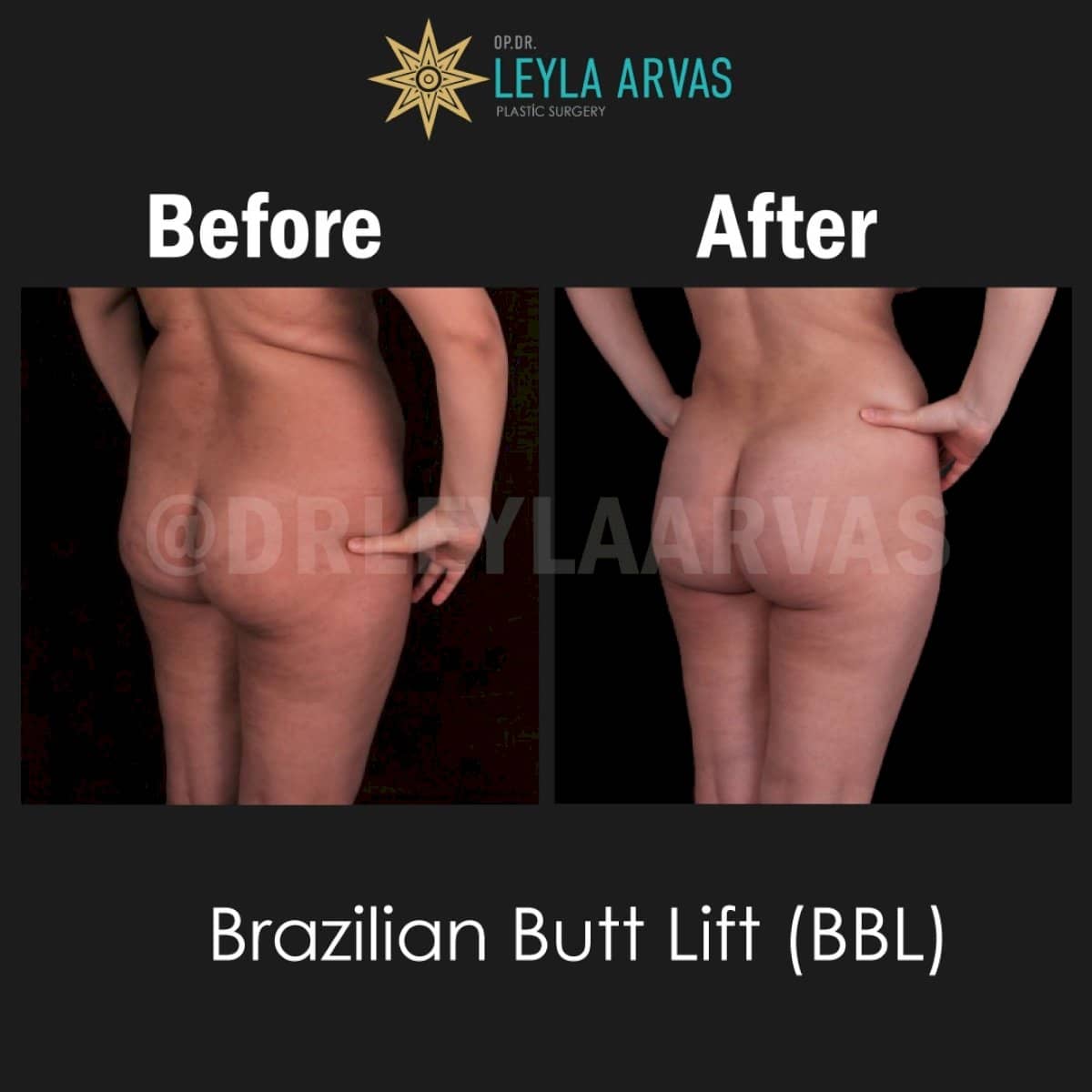 Case 17943 - Brazilian Butt Lift