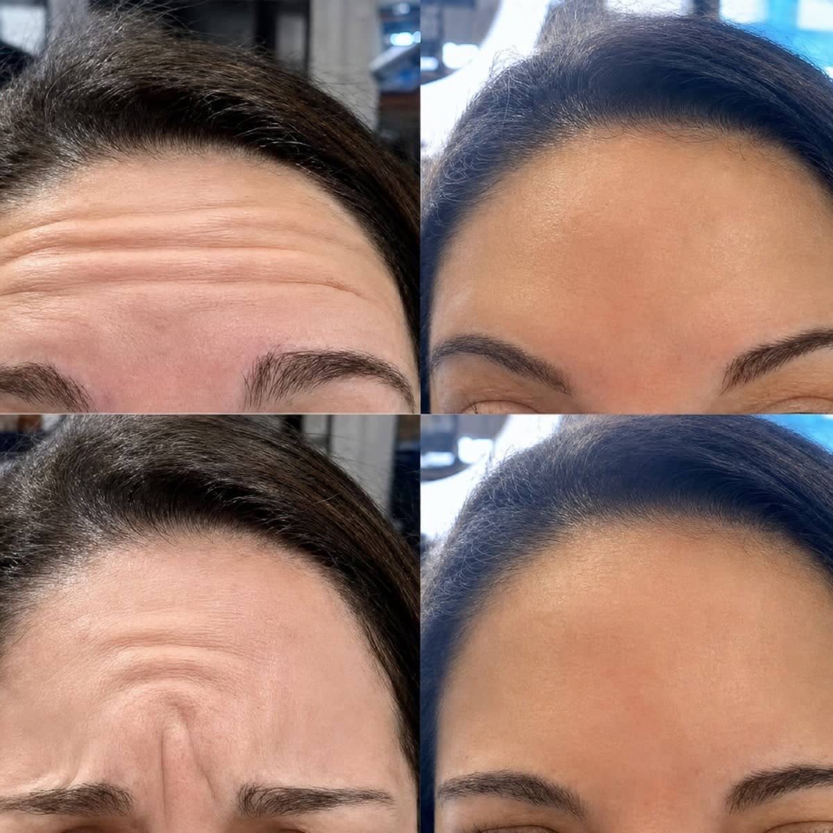 Case 17981 - Botox injections