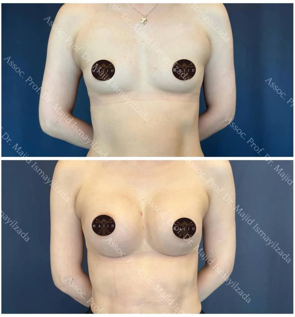 Case 18068 - breast augmentation