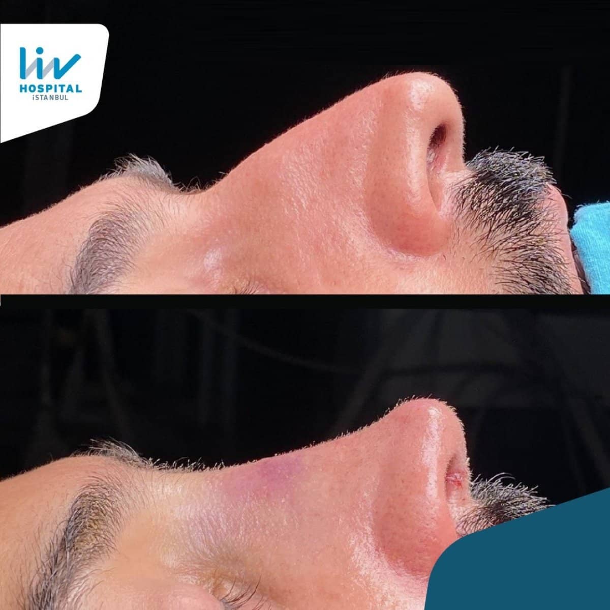 Case 18069 - rhinoplasty