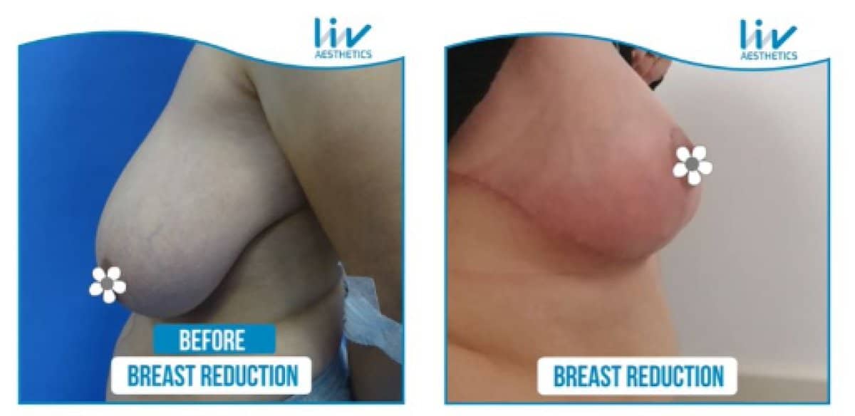 Case 18076 - breast reduction