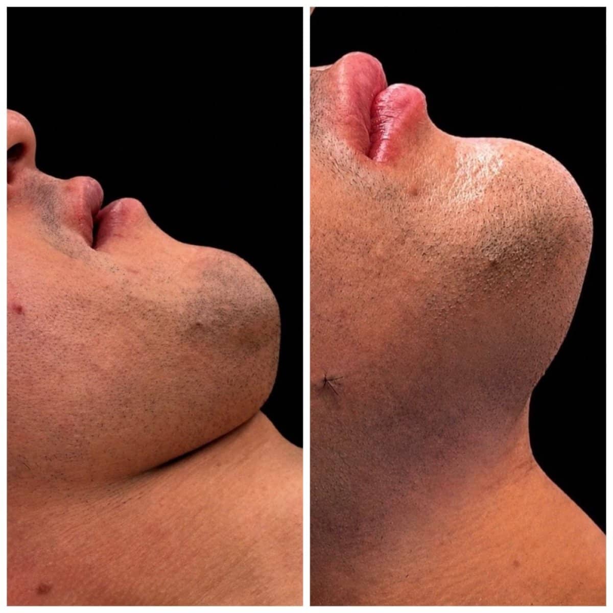 Case 18081 - sliding genioplasty