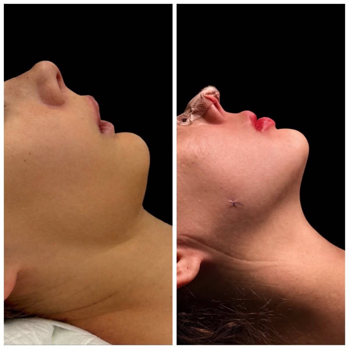 Case 18082 - sliding genioplasty