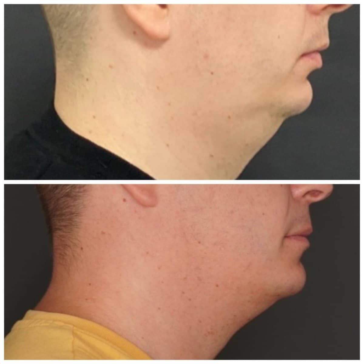 Case 18083 - sliding genioplasty