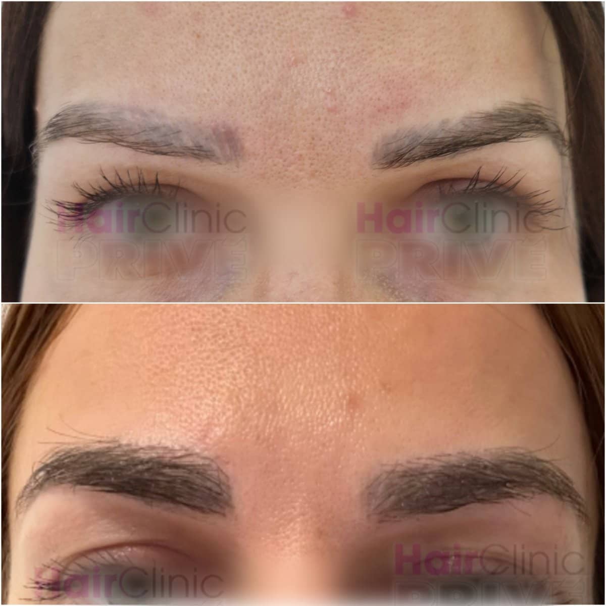 Case 18095 - eyebrow transplant