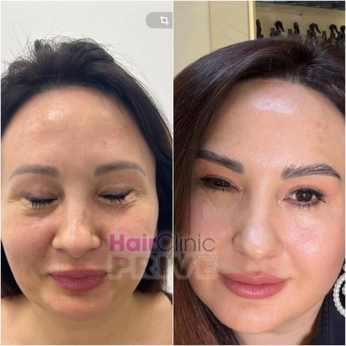 Case 18097 - facial rejuvenation