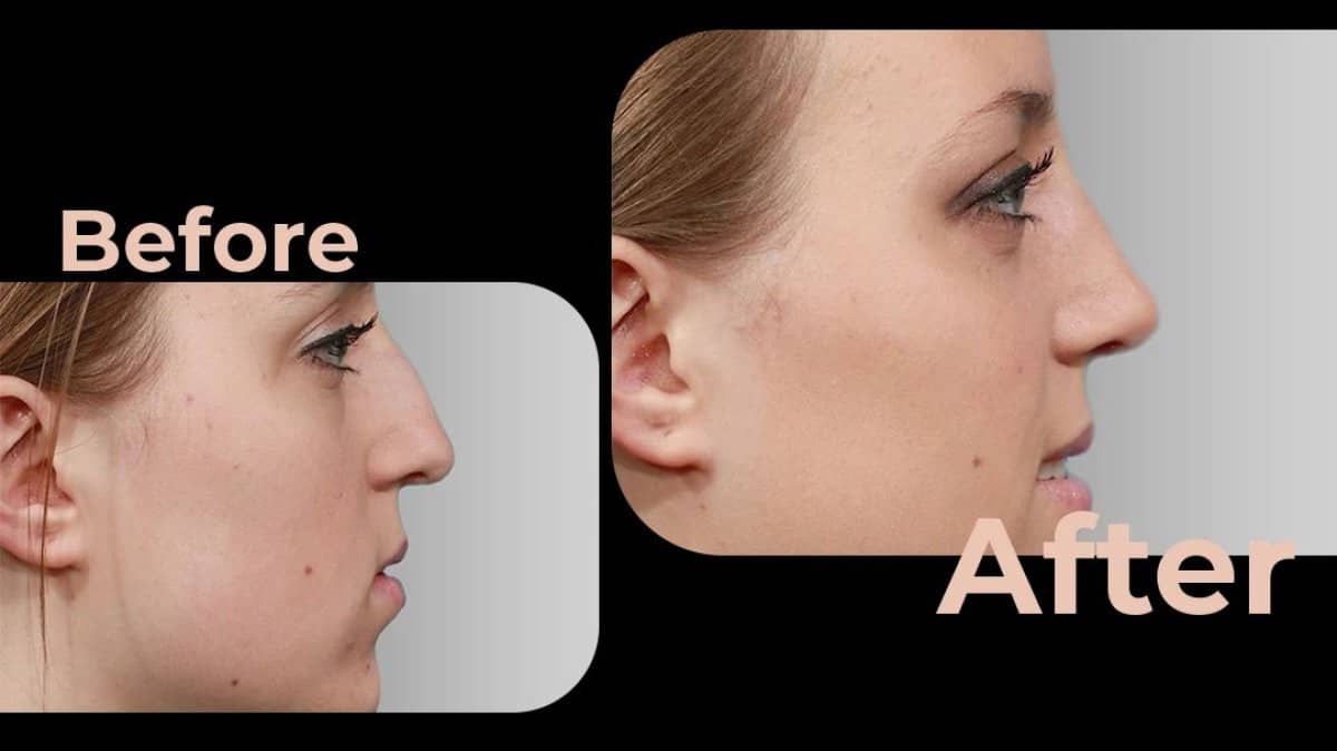Case 18182 - rhinoplasty