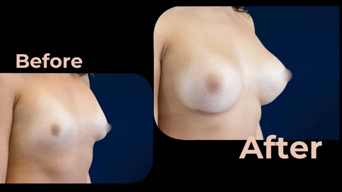 Case 18184 - breast augmentation
