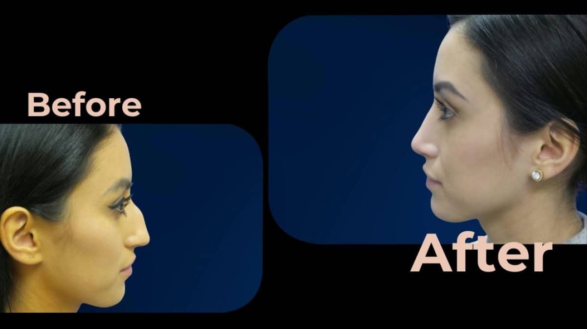 Case 18185 - rhinoplasty