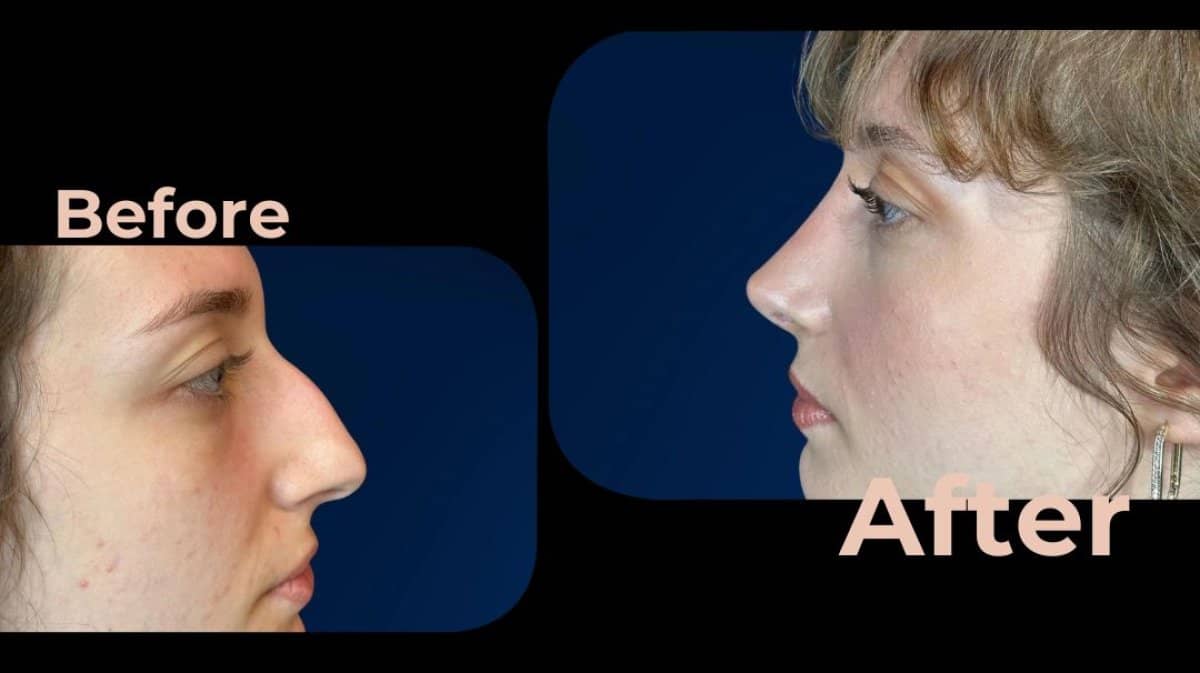 Case 18186 - rhinoplasty