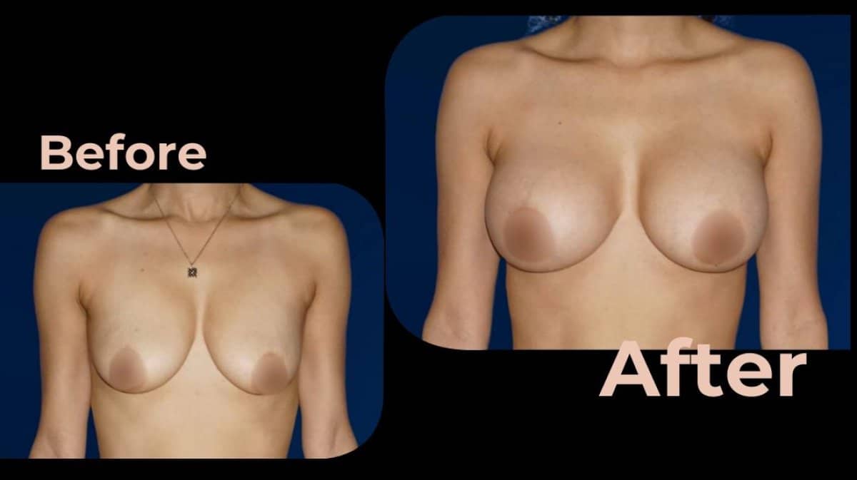 Case 18187 - breast augmentation