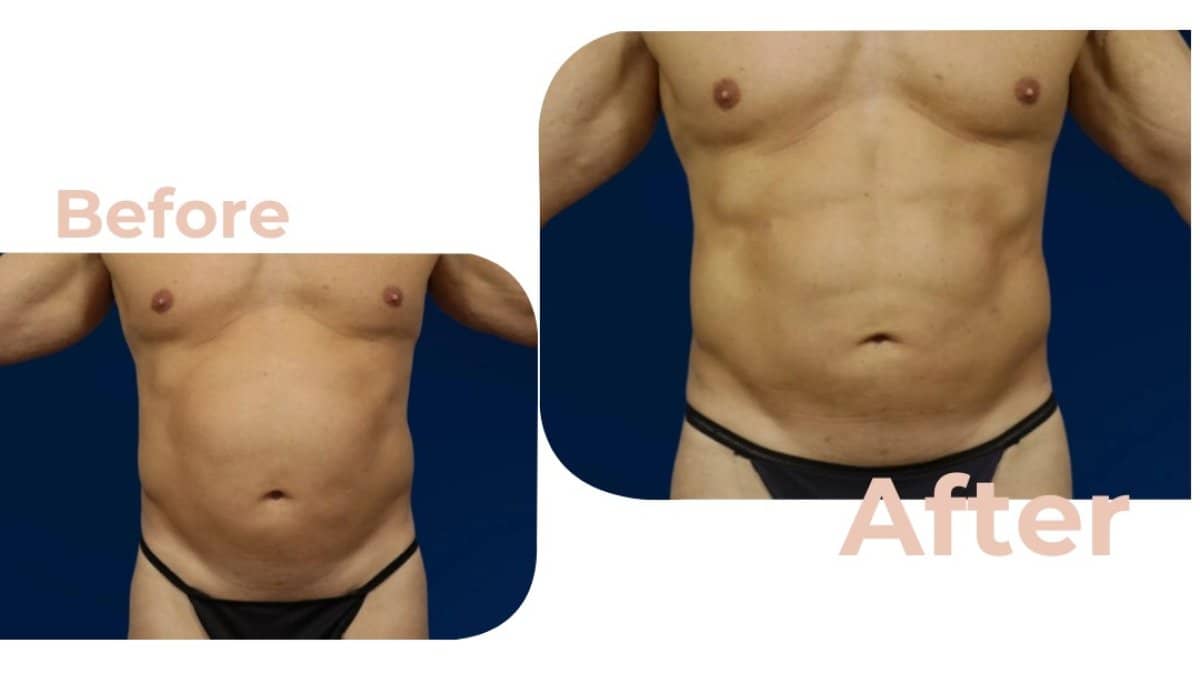 Case 18189 - liposuction