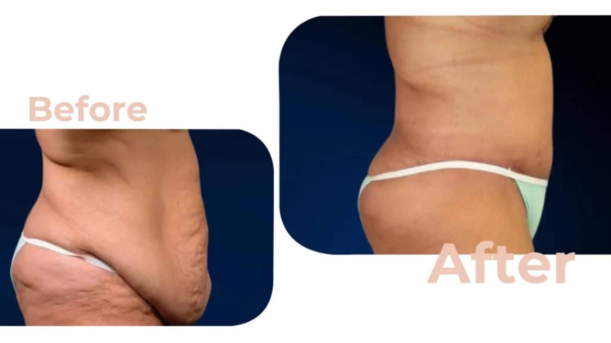 Case 18191 - tummy tuck