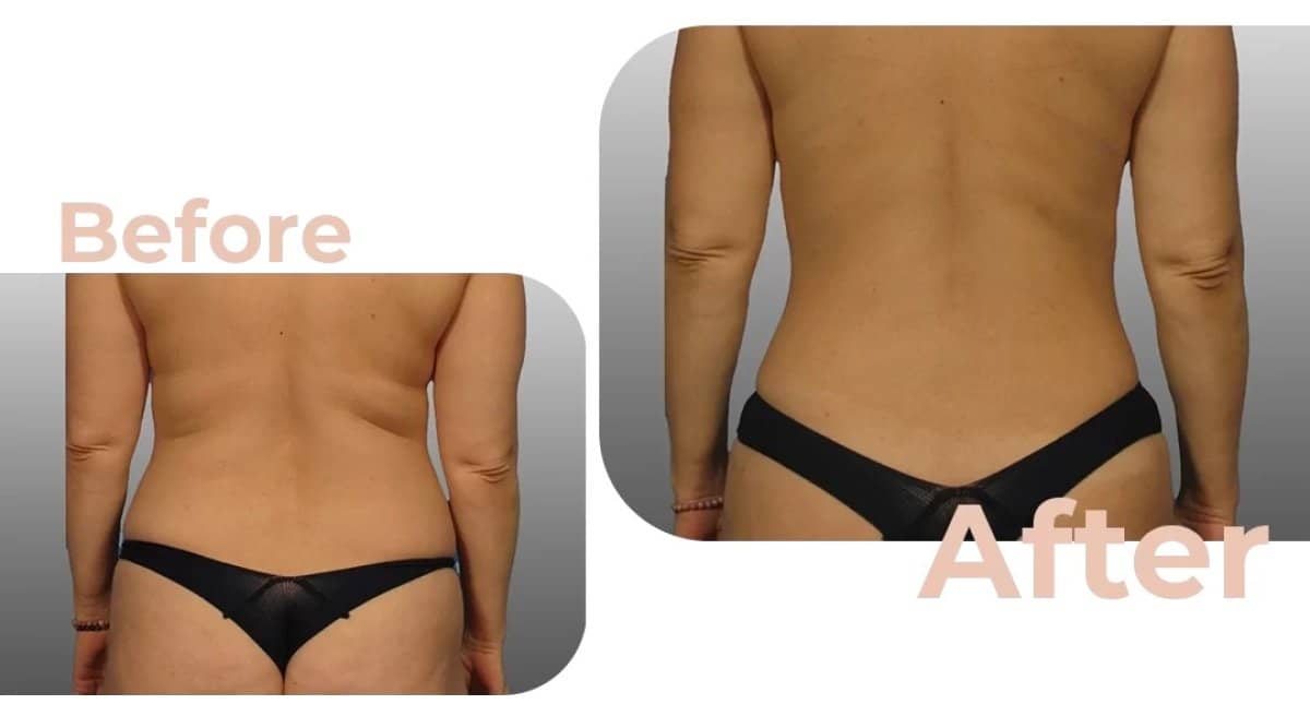 Case 18193 - liposuction