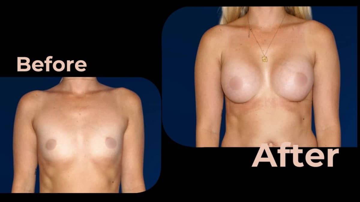 Case 18195 - breast augmentation
