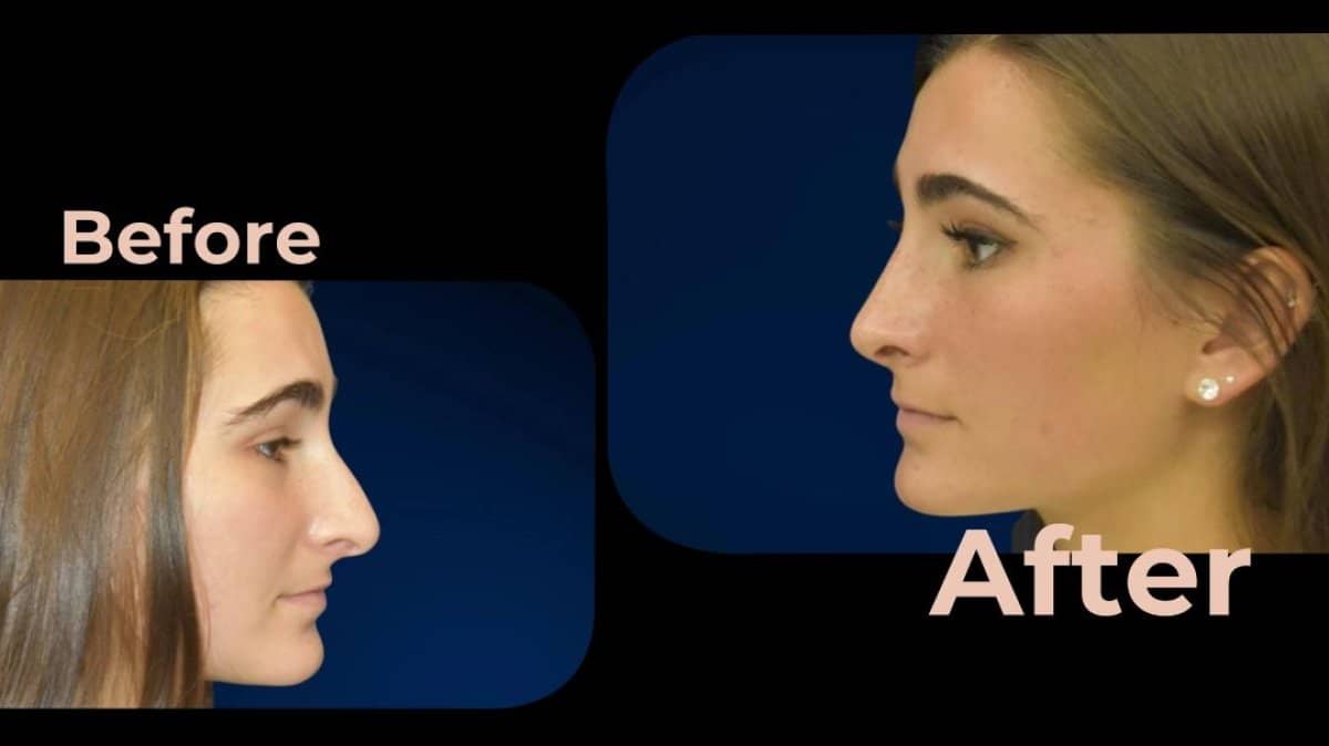 Case 18198 - rhinoplasty
