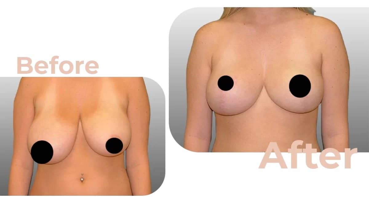 Case 18199 - breast lift