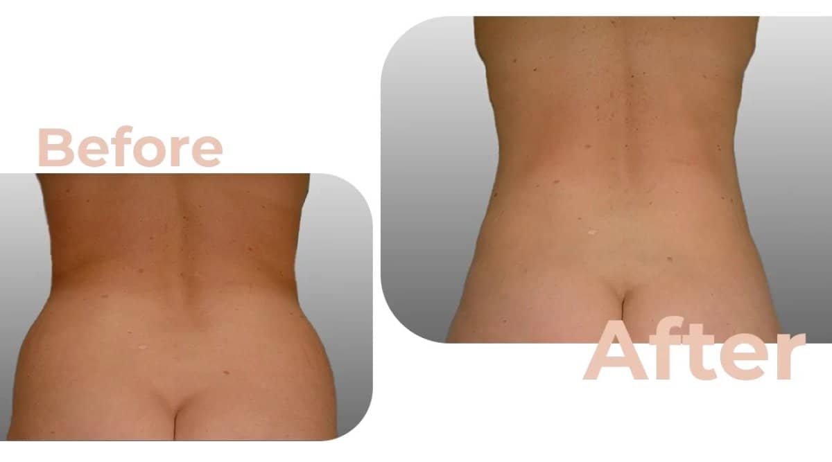 Case 18201 - liposuction
