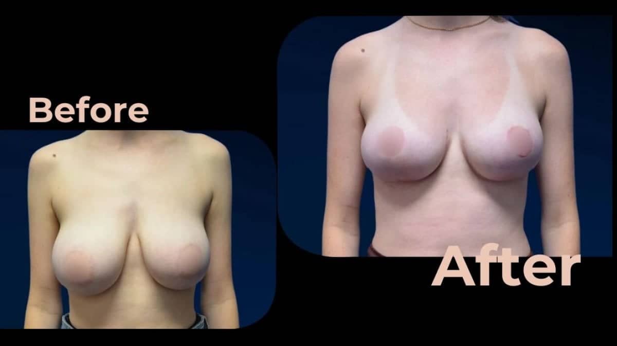 Case 18202 - breast implants with lift