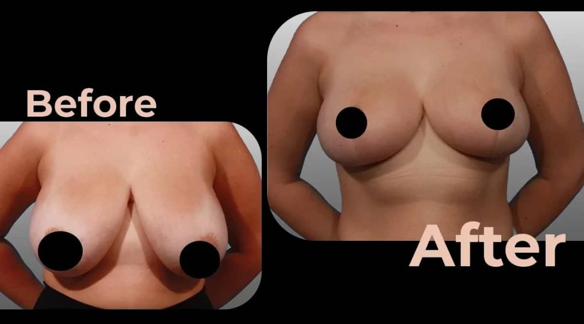 Case 18203 - breast implants with lift