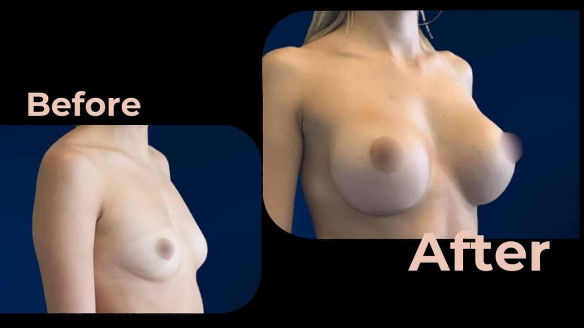 Case 18208 - breast augmentation