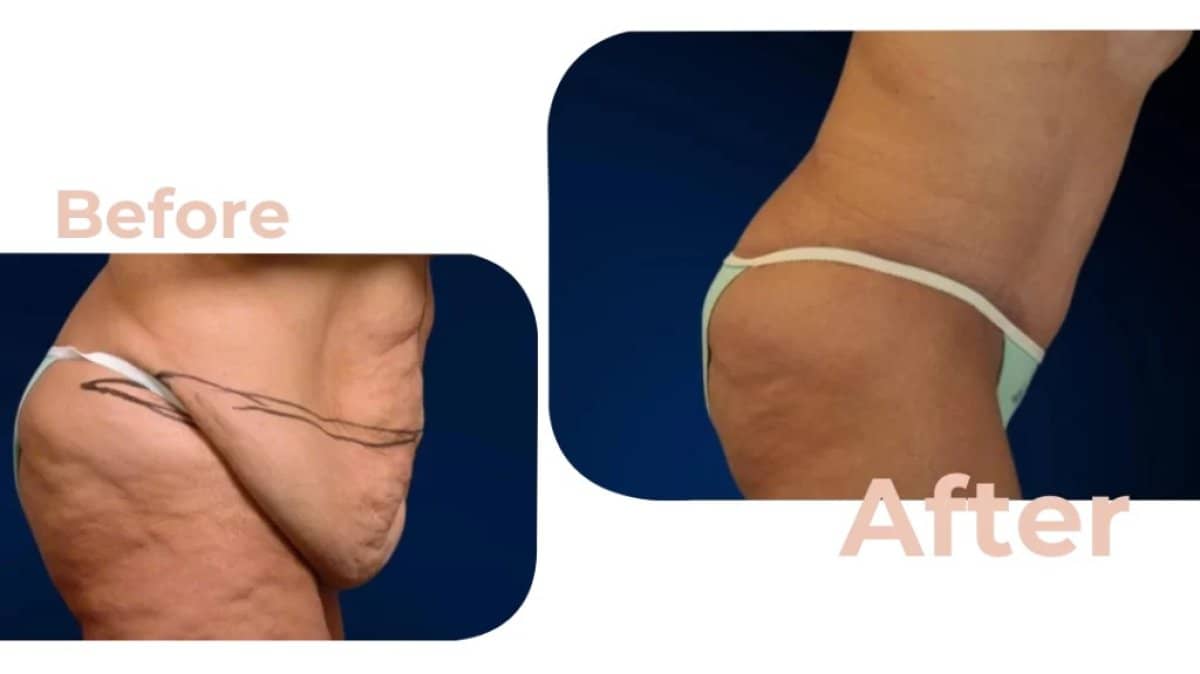 Case 18210 - tummy tuck