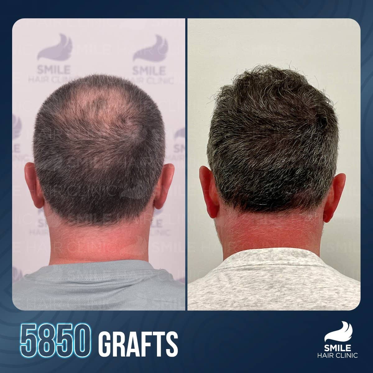 Case 18232 - FUE hair transplant
