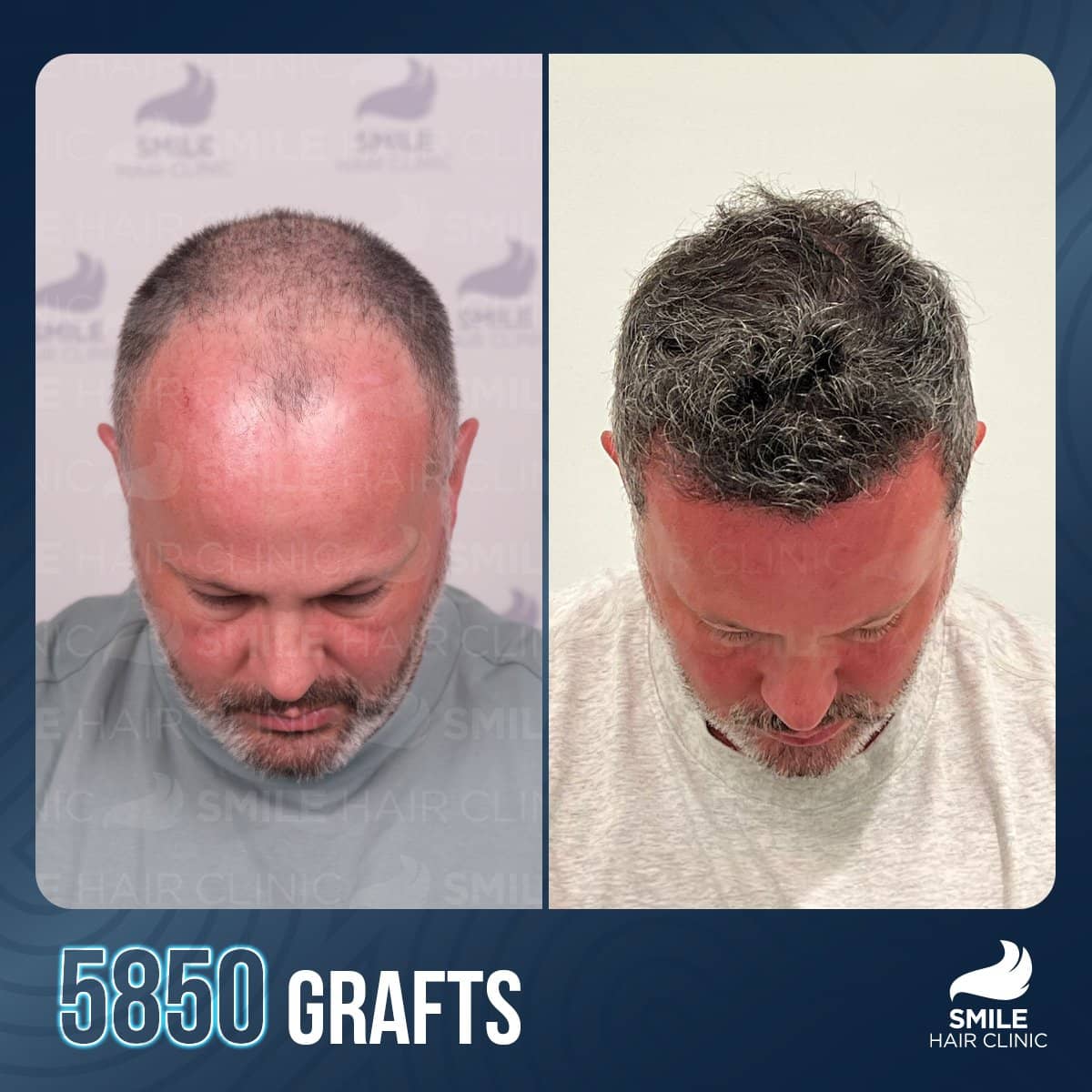 Case 18235 - FUE hair transplant