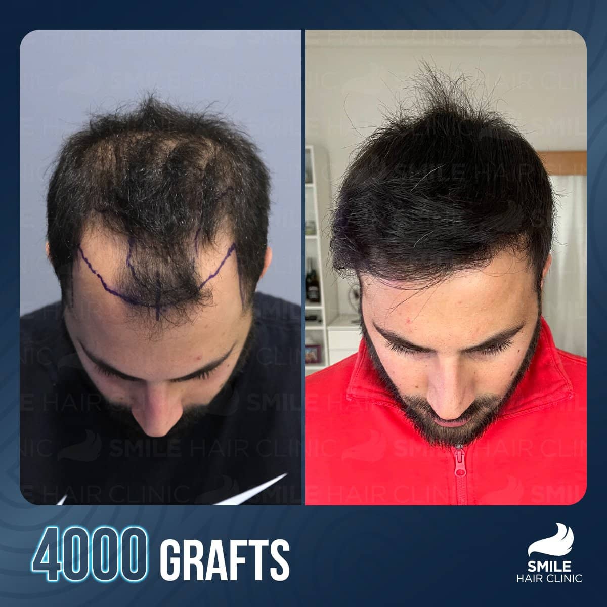 Case 18238 - FUE hair transplant