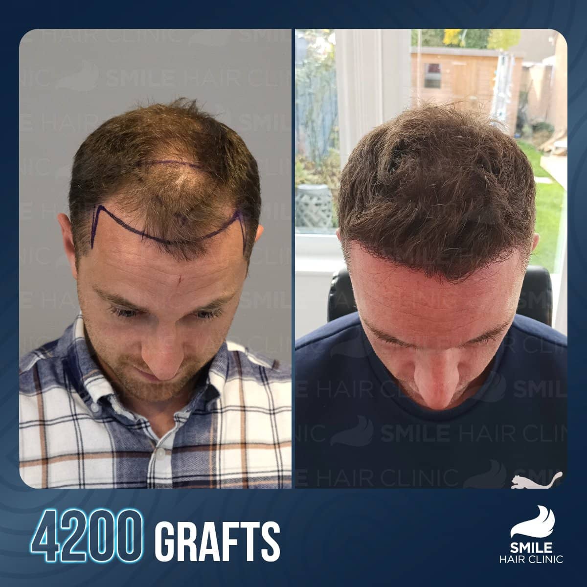 Case 18239 - FUE hair transplant