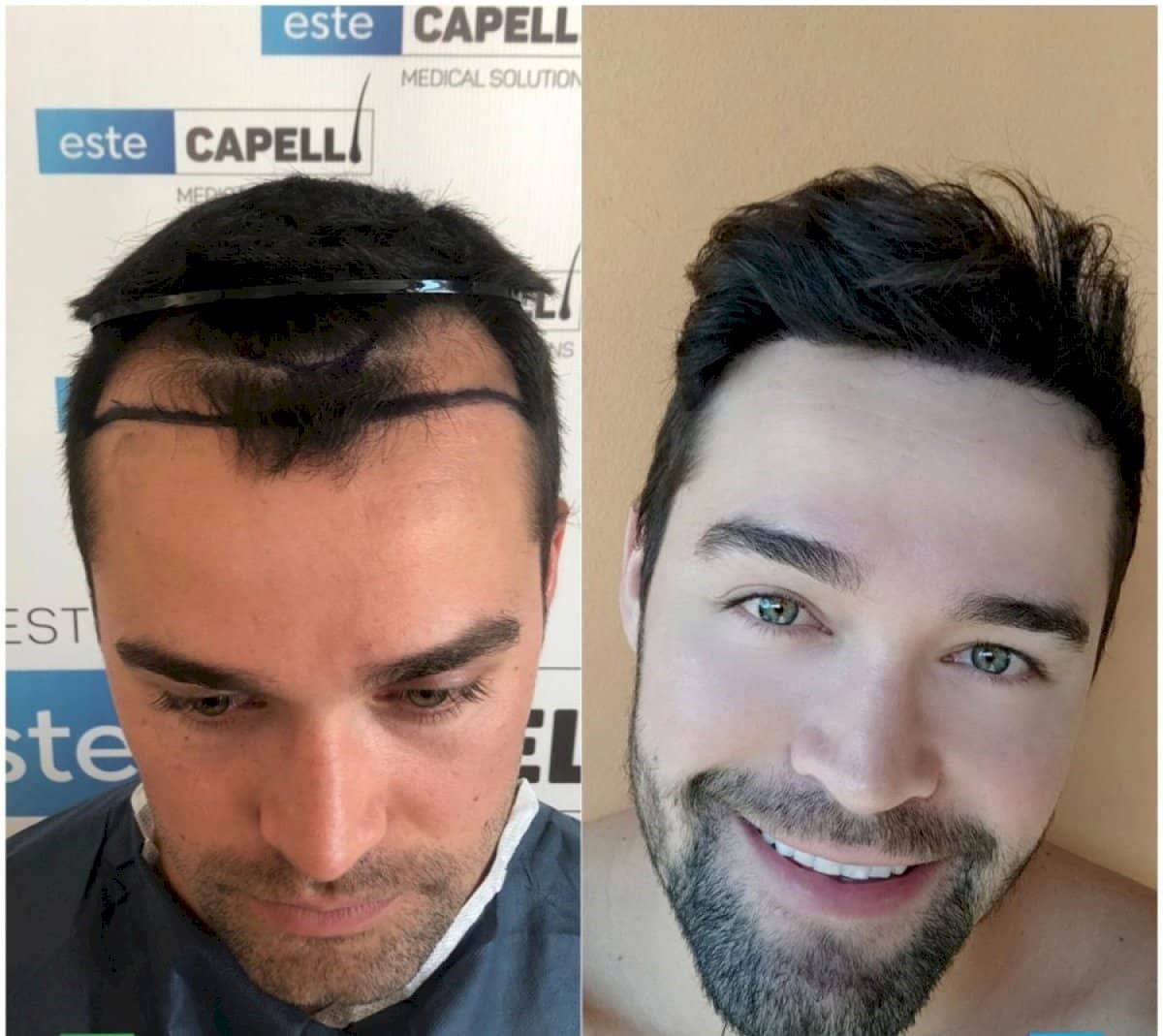 Case 18245 - DHI hair transplant