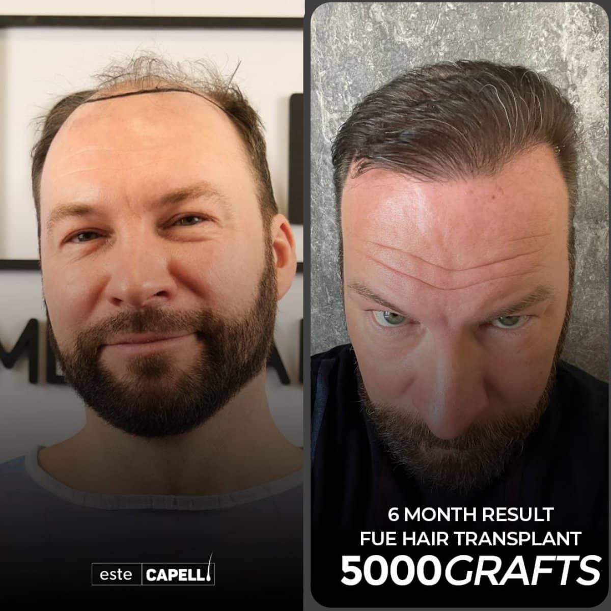 Case 18248 - FUE hair transplant