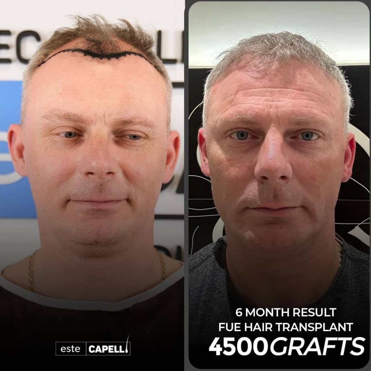 Case 18252 - FUE hair transplant
