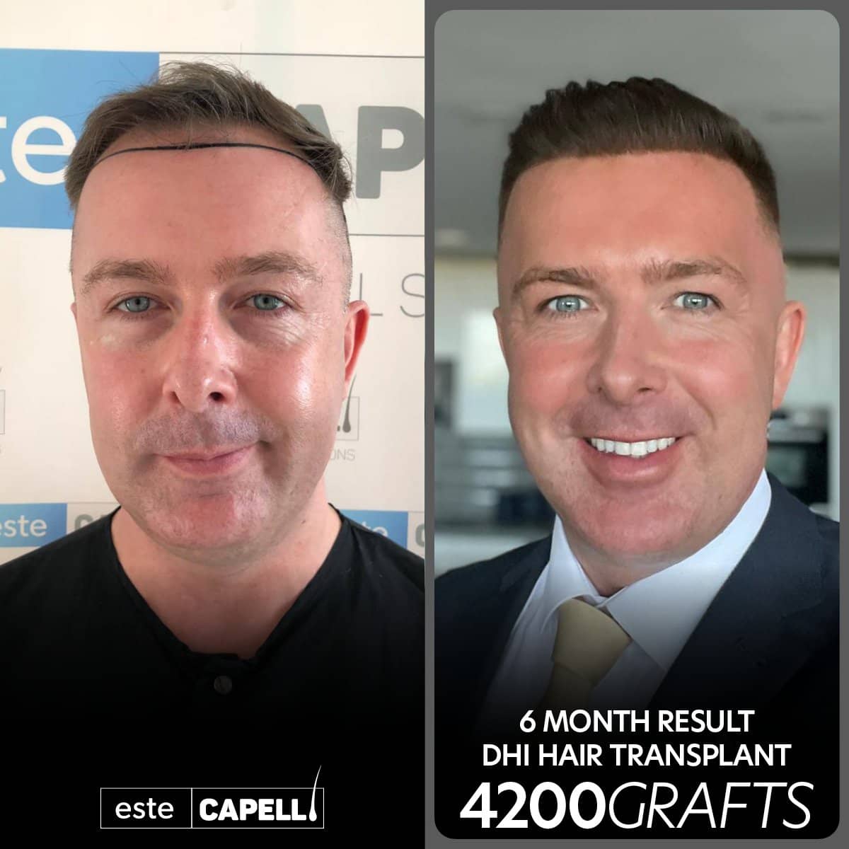 Case 18254 - before and after