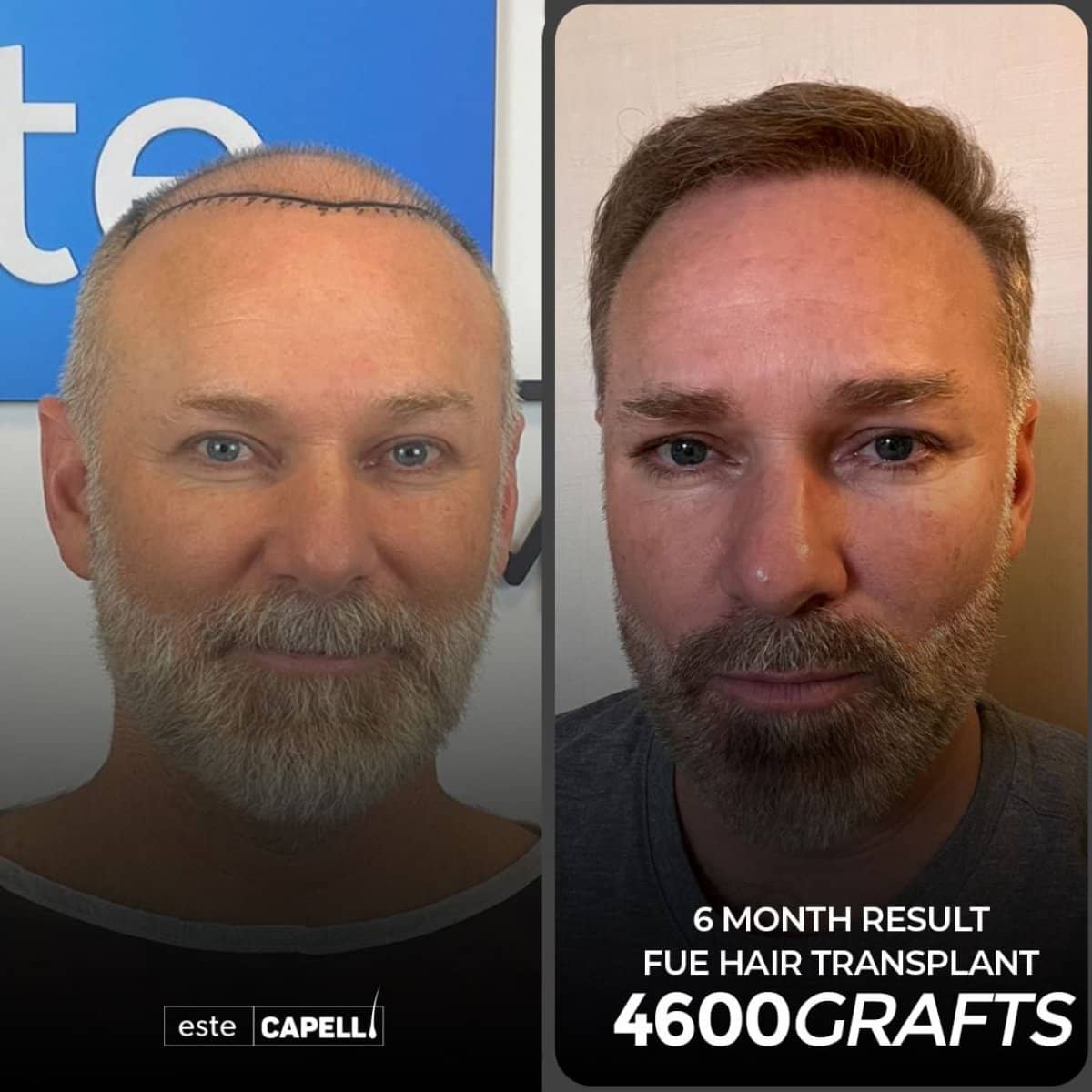 Case 18255 - FUE hair transplant