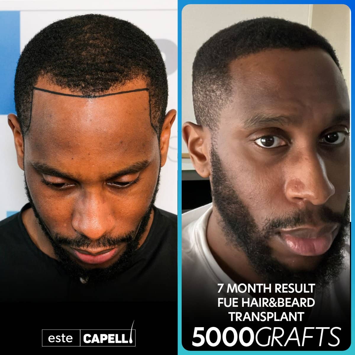 Case 18259 - beard and hair transplant