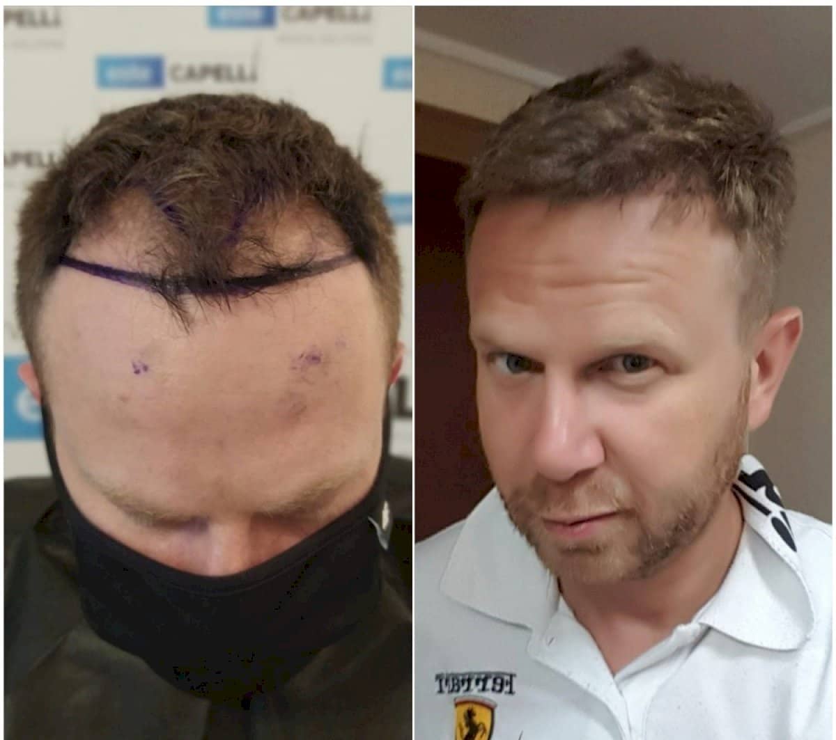 Case 18263 - FUE hair transplant