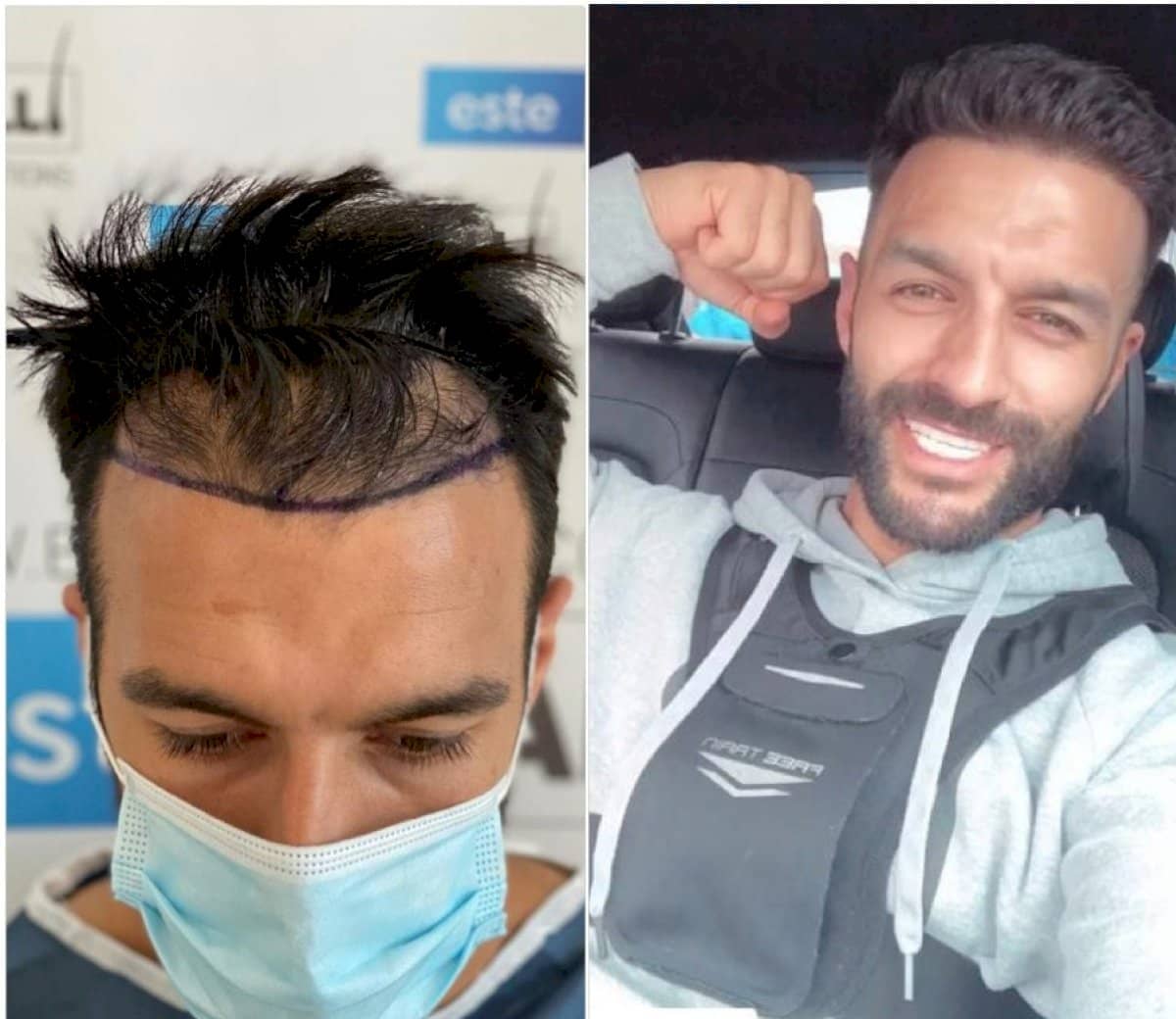 Case 18264 - FUE hair transplant