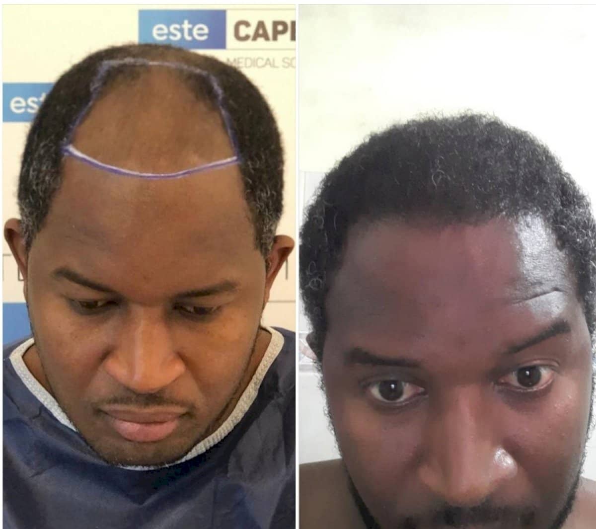 Case 18265 - FUE hair transplant