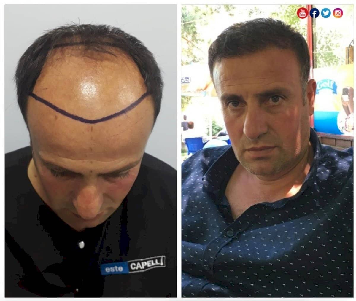 Case 18271 - FUE hair transplant