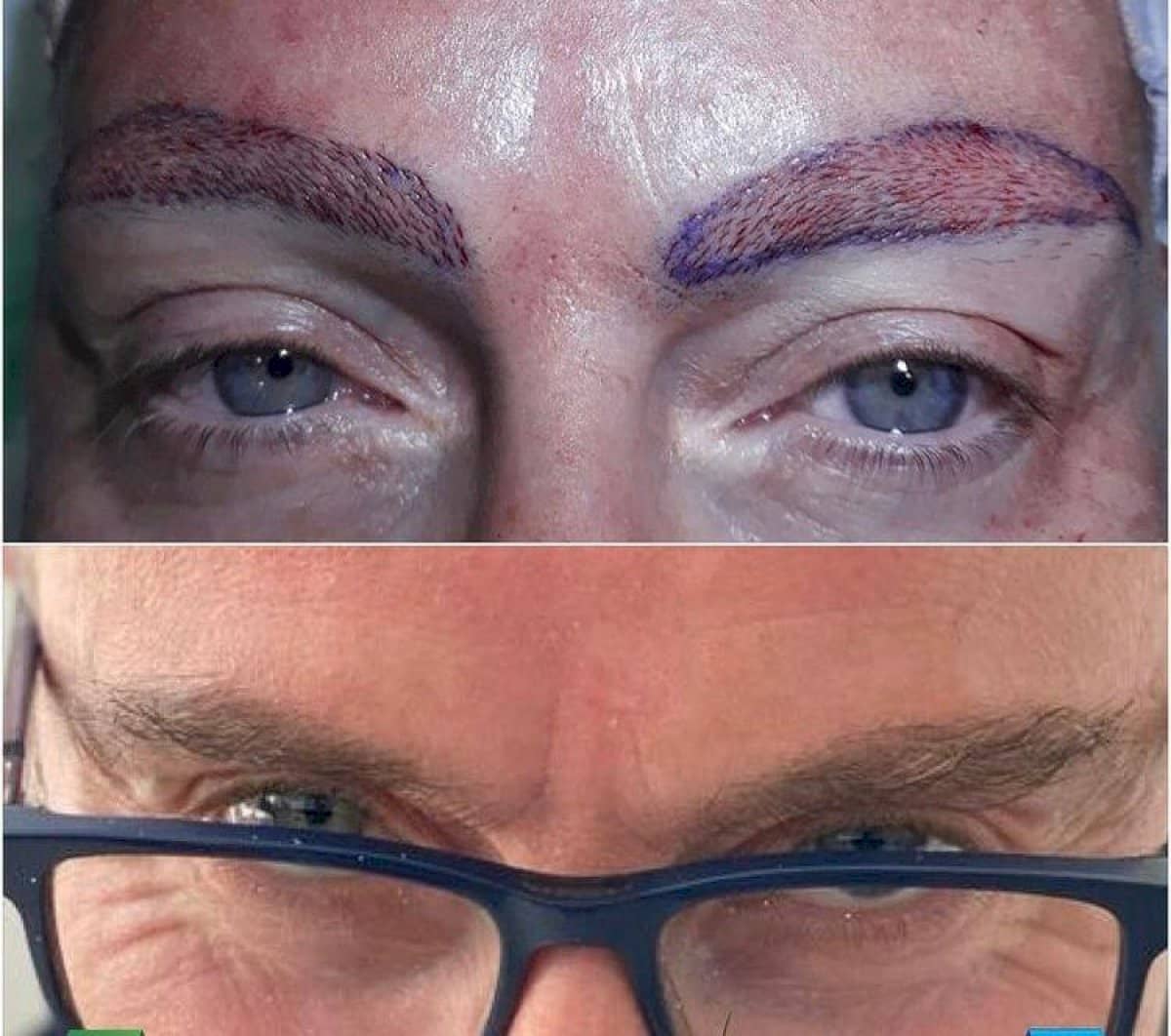 Case 18273 - eyebrow transplantation