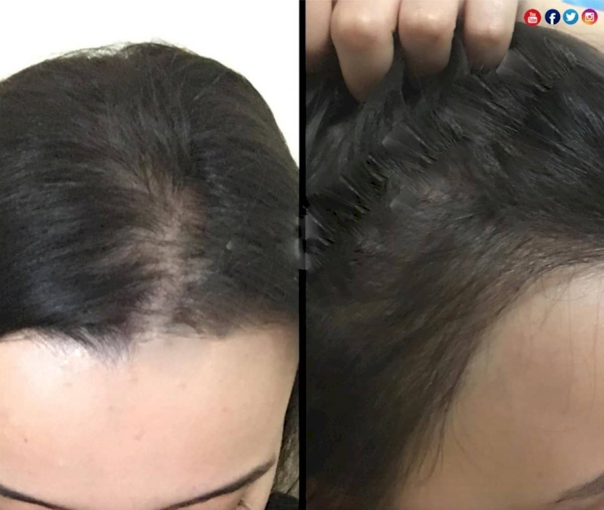 Case 18274 - DHI hair transplant