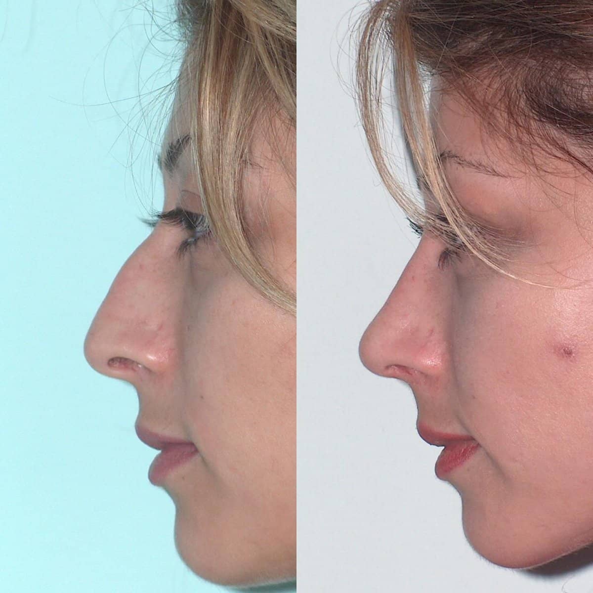 Case 18306 - nasal hump removal