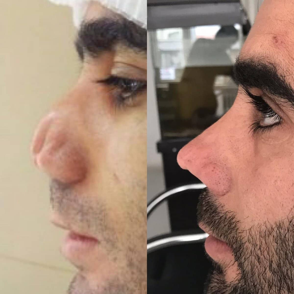 Case 18307 - rhinoplasty