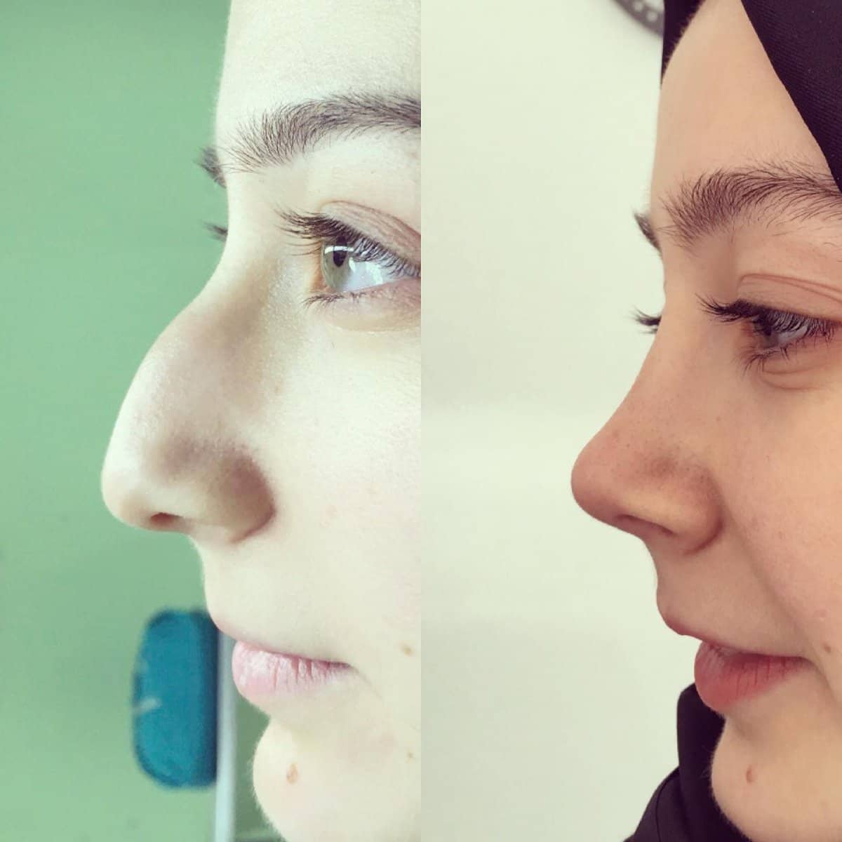 Case 18308 - rhinoplasty