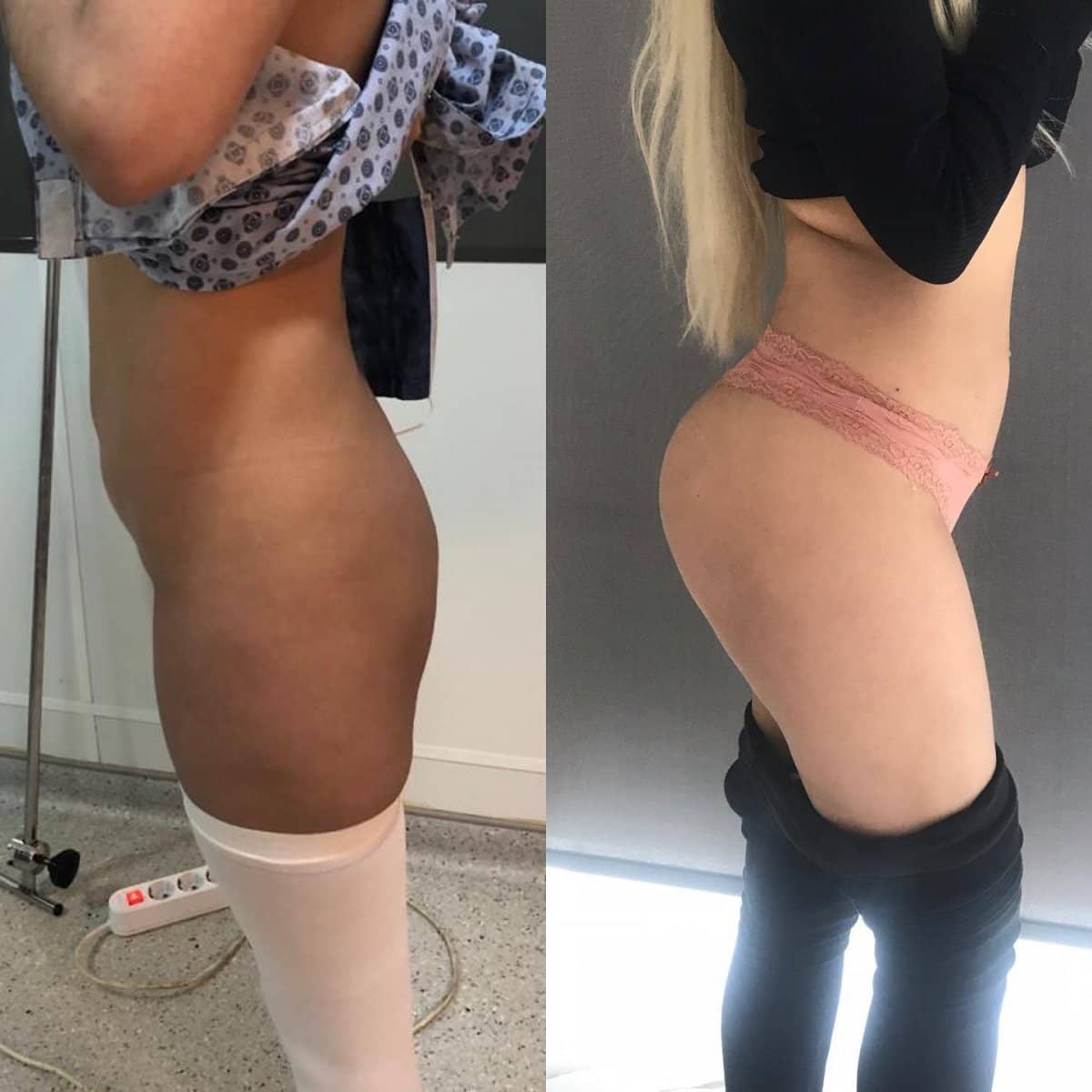 Case 18311 - Brazilian Butt Lift