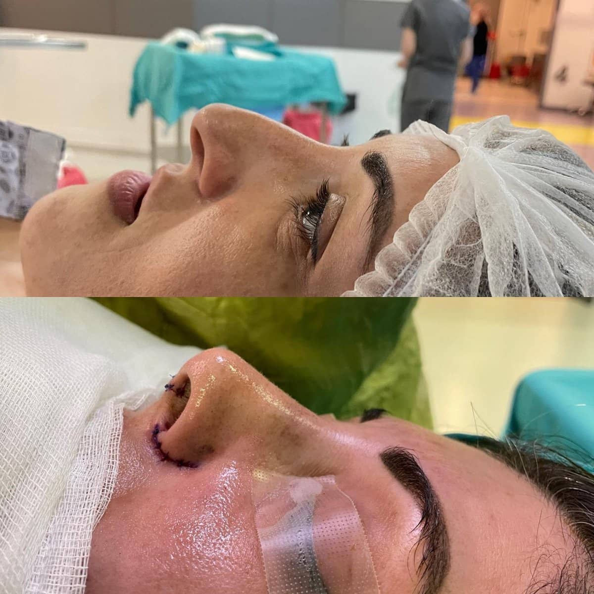 Case 18312 - rhinoplasty