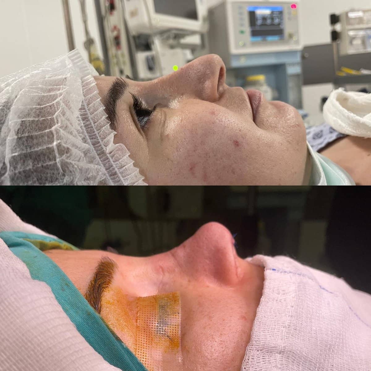 Case 18313 - rhinoplasty
